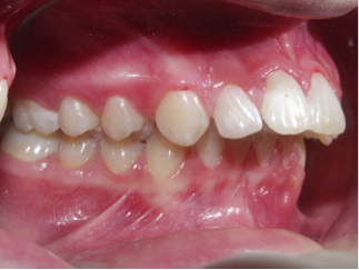 Anomalies alvéolo-dentaires 