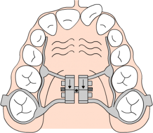 Disjoncteur inter-maxillaire
