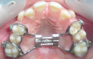 disjoncteur inter maxillaire en denture adolescente