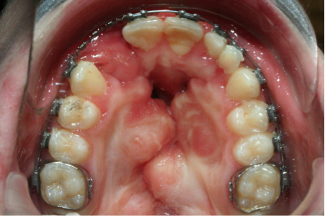 Correction d'un bec de lievre ou fente palatine par traitement orthodontique