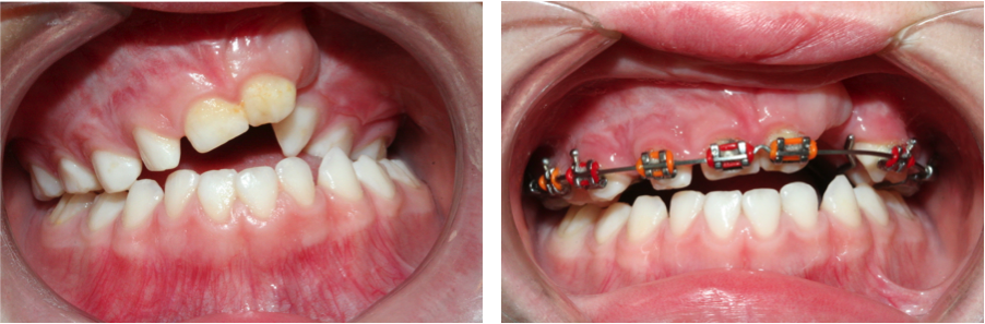 fente palatine unilatérale gauche, en denture temporaire
