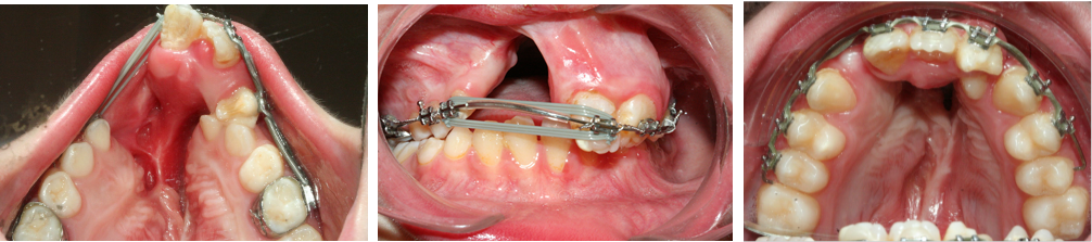 Traitement orthodontique d'un cas de bec de lievre avec fente bilaterale