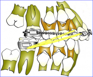 thérapeutique orthodontique du Dr Jean-Jacques Aknin - DAC Distal Active Concept