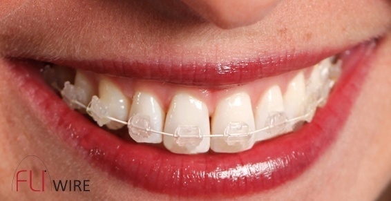 appareil dentaire transparent