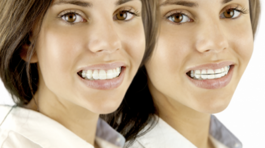 Traitement orthodontique: Deux types de contention differents