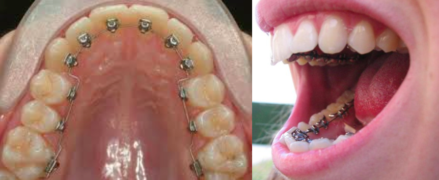 appareil dentaire - traitement lingua
