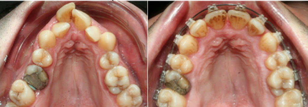 Endognathie maxillaire, anomalies de forme d’arcade et encombrement dentaire majeur