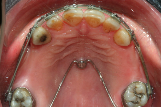 traitement orthodontique avec une vis d'ancrage dans le palais