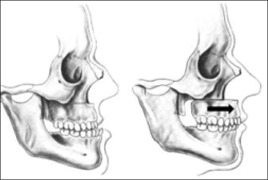 traitement chirurgicale du maxillaire d'une prognathie