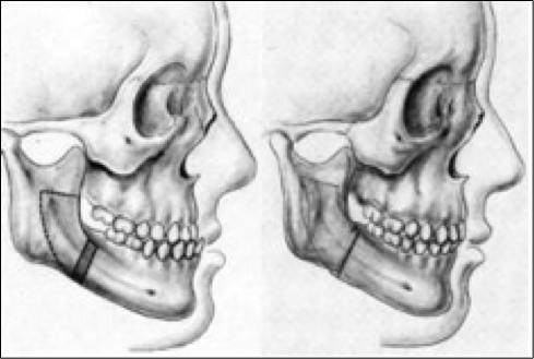 traitement orthodontique et chirurgicale d'une prognathie