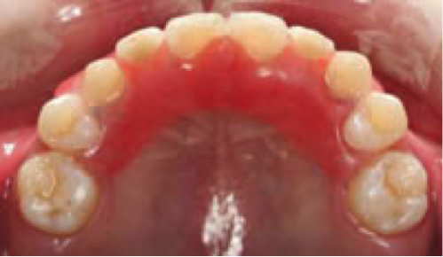 fin de traitement orthodontique en technique linguale