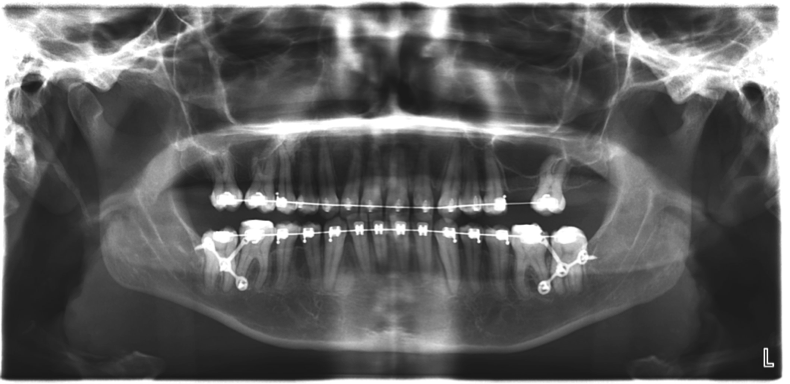 traitement chirurgico-orthodontique - plaques vissées