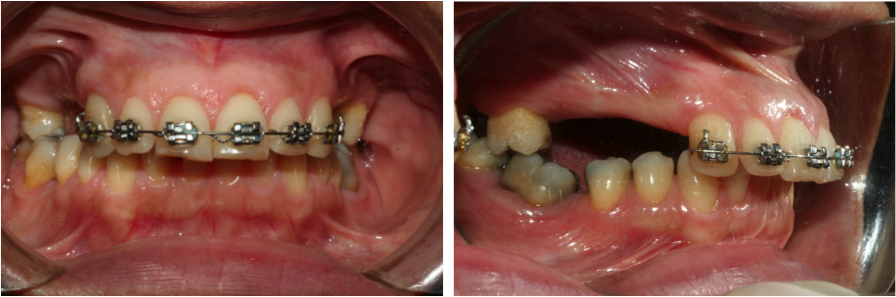 Exemple pour une orthodontie rapide: la fiabilité de la miniplaque vissée sur laquelle est installée une traction pour reculer l’ensemble de l’arcade maxillaire en un temps.