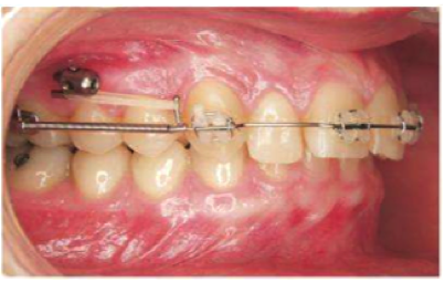 Appareil orthodontique - vis ancrage