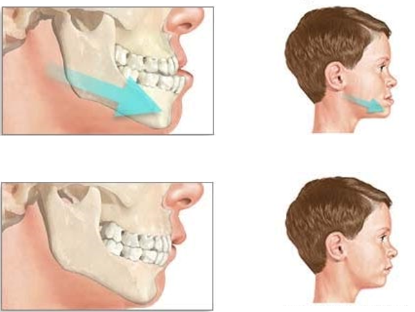 Cas de prognathie en orthodontie