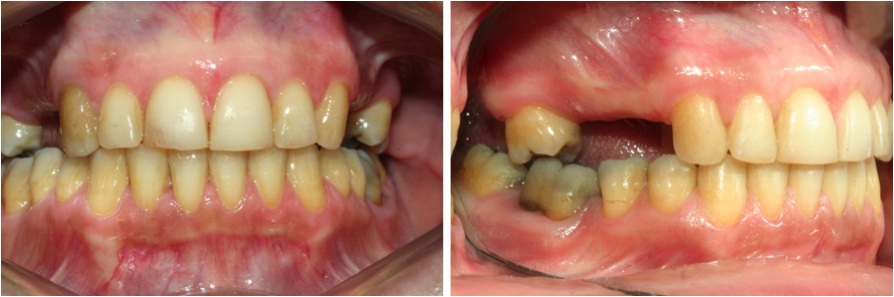 Les vis d'ancrage en orthodontie - Dr Chpindel, Orthodontiste